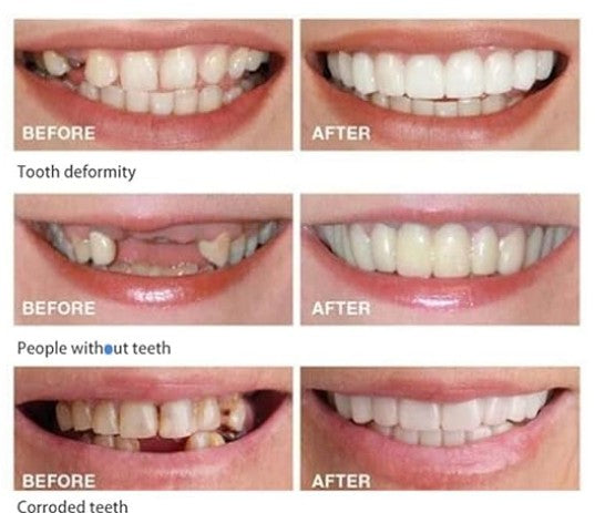 CARILLAS DENTALES 2X1 Snap-On Smile ENVIO GRATIS