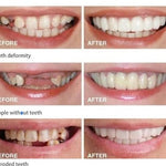 CARILLAS DENTALES 2X1 Snap-On Smile ENVIO GRATIS