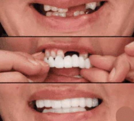 CARILLAS DENTALES 2X1 Snap-On Smile ENVIO GRATIS