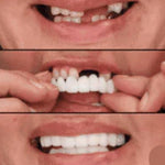 CARILLAS DENTALES 2X1 Snap-On Smile ENVIO GRATIS