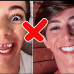 CARILLAS DENTALES 2X1 Snap-On Smile ENVIO GRATIS