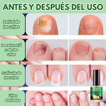 🌱JoyPretty™ el cuidado intensivo de uñas- Q160+ envio gratis  (manos y pies)